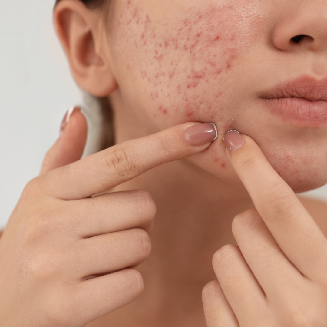 Comprendre la Dermatillomanie : Lorsque le Besoin de Se Gratter Devient un Trouble